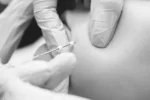 Fios Aptos - Lifting sem cirurgia - Belo Horizonte - Nuance Clinic